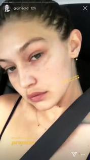 Gigi Hadid mostra le sue macchie solari su Instagram