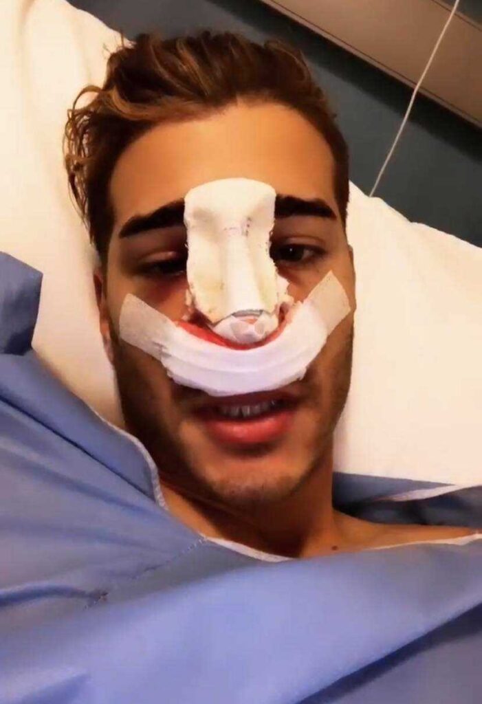 Nicolò Ferrari si è rifatto il naso: l’ex corteggiatore di Uomini e Donne replica agli attacchi social