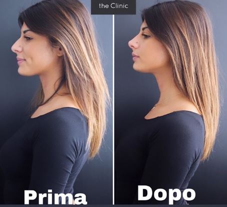 Giulia Cavaglia di Uomini e Donne si è rifatta il naso: il prima e il dopo dell’ex tronista del trono classico