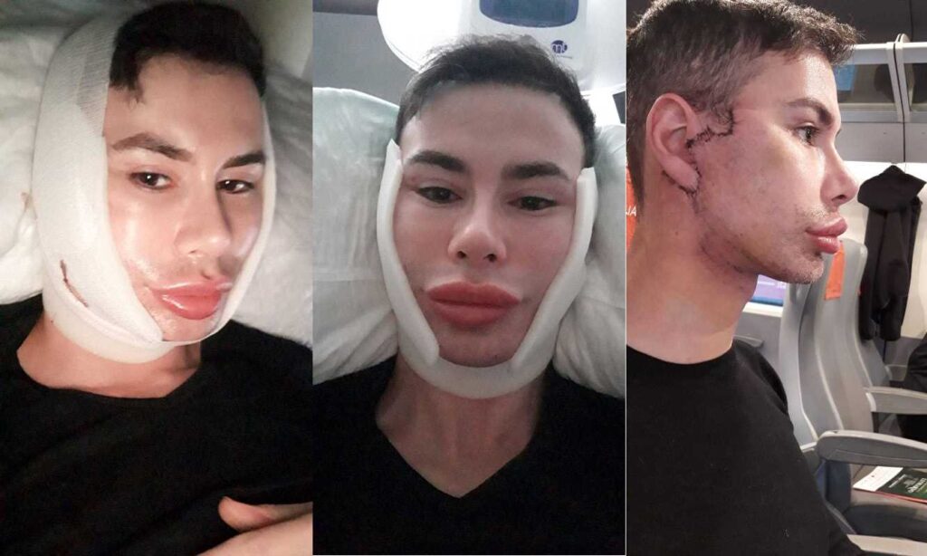 Angelo Sanzio del Grande Fratello ha rimosso la massa di acido ialuronico dagli zigomi: le foto del post intervento del Ken italiano