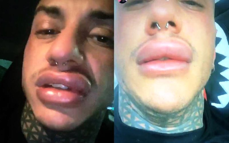 Francesco Chiofalo finisce al pronto soccorso: “Le mie labbra si gonfiano da sole”
